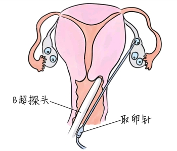 小儿退烧推拿手法 5种上海捐卵宝宝退烧按摩方法